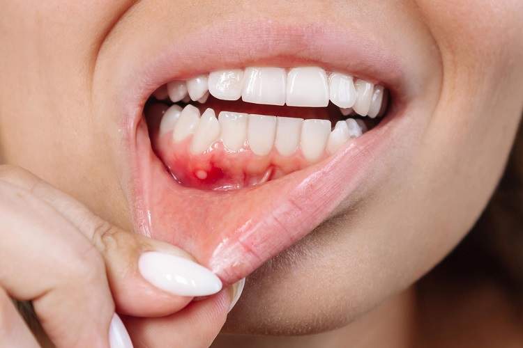 وقتی پوسیدگی دندان به مغز حمله میکند