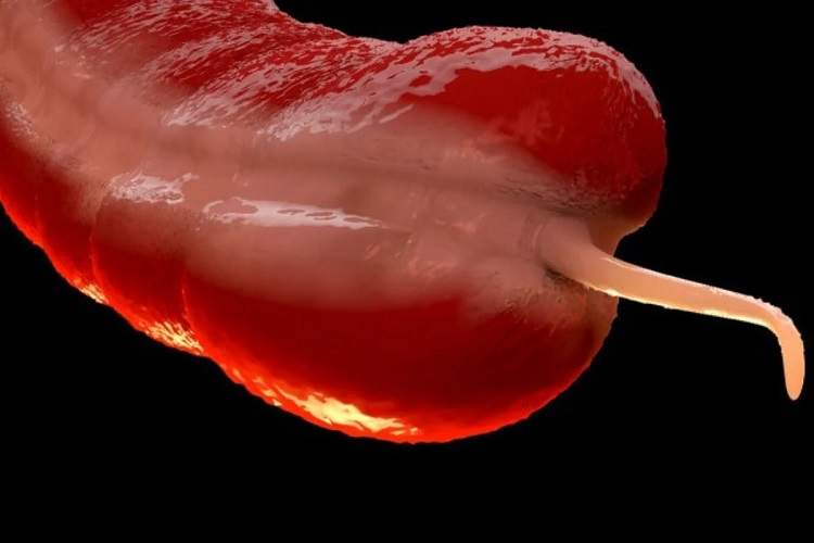 افزایش نگرانکننده سرطان آپاندیس در میان جوانان